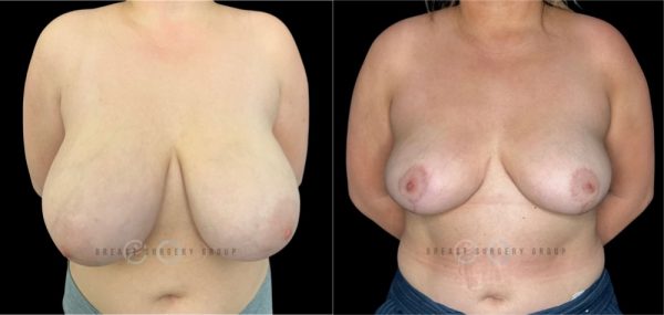 10765-breast-reduction-nyc-plastic-surgery-before-and-after-photo