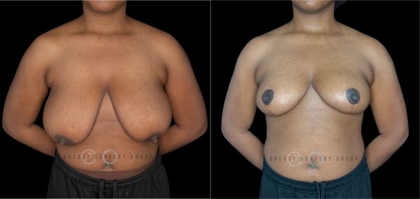 10822-breast-reduction-nyc-plastic-surgery-before-and-after-photo