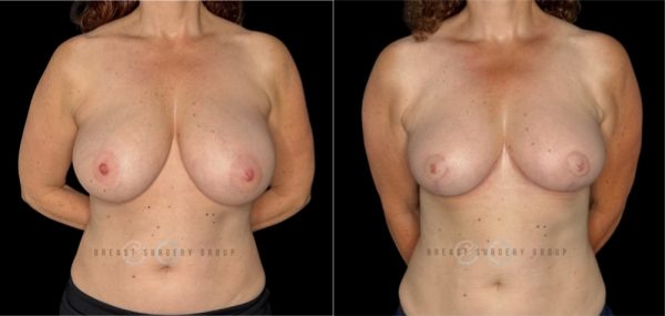 12101-breast-reduction-plastic-surgery-before-and-after-photo-1