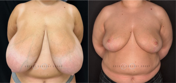 3141-breast-reduction-nyc-plastic-surgery-before-and-after-photo