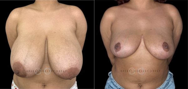 4609-breast-reduction-plastic-surgery-before-and-after-photo-1