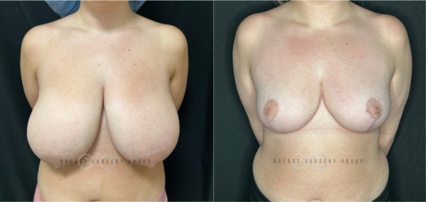 8267-breast-reduction-nyc-plastic-surgery-before-and-after-photo