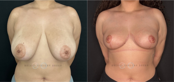 9749-breast-reduction-nyc-plastic-surgery-before-and-after-photo