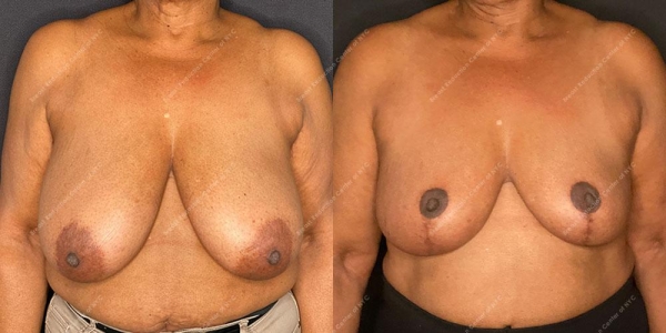 breast-reduction-before-and-after-BR.2466.AP .9month