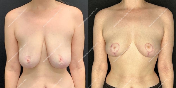breast-reduction-before-and-after-BR.2674.AP .1year.lipo 