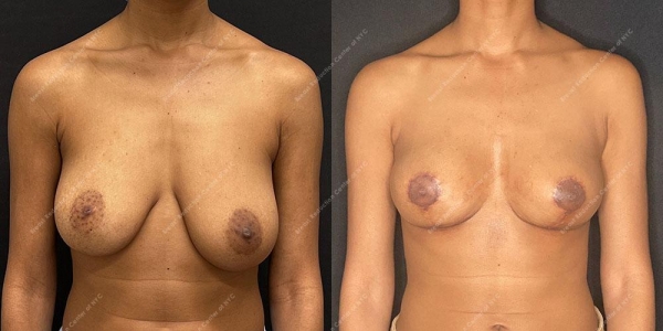 breast-reduction-before-and-after-BR.FH .4904.AP .2month.lipo 