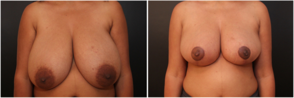 breast-reduction-cb-before-and-after