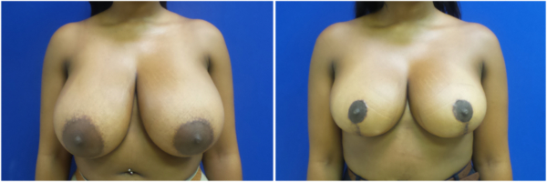 breast-reduction-dc-before-and-after