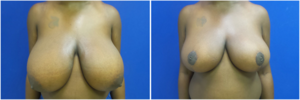 breast-reduction-tr-before-and-after
